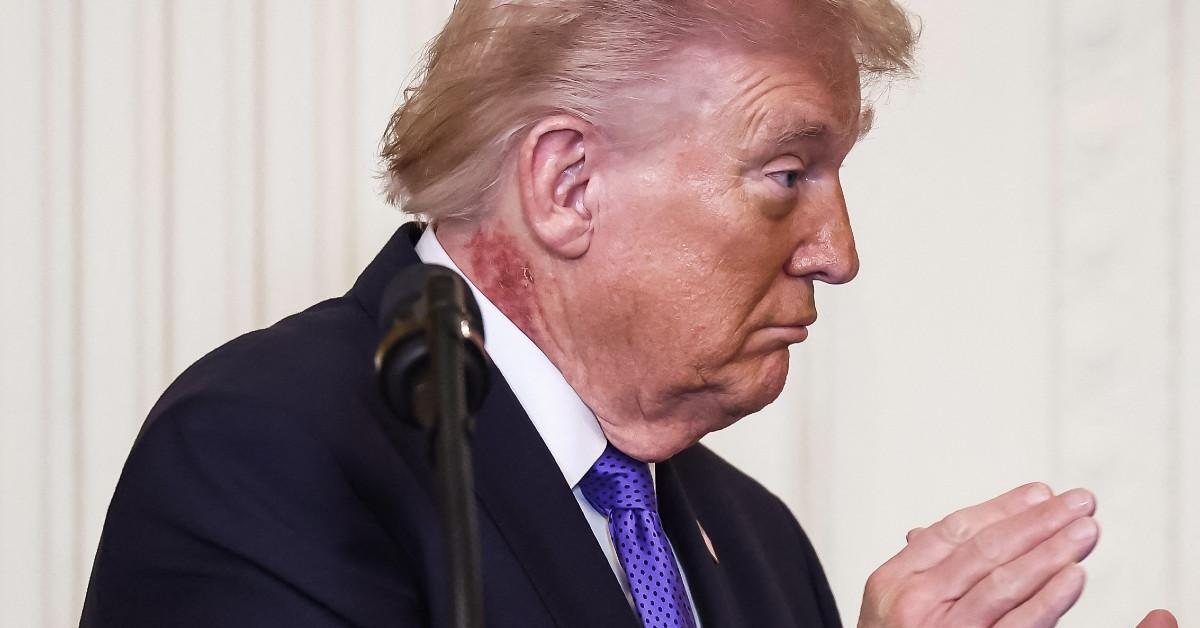 Red Spot on Trump's Neck Fuels Questions — White House Says It's a Routine Cream